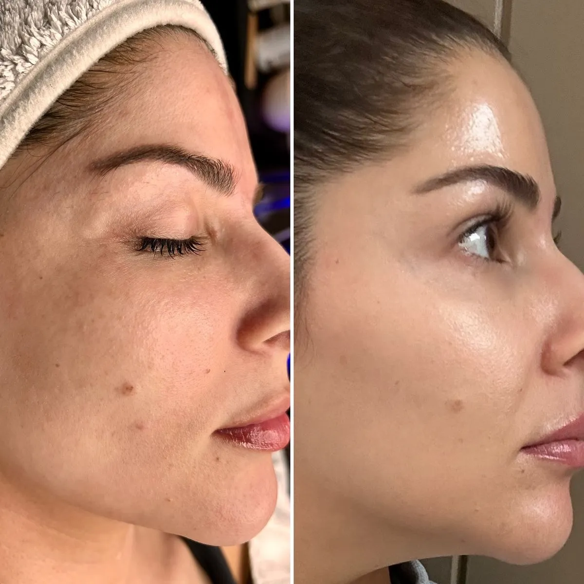 PRP Treatment Results